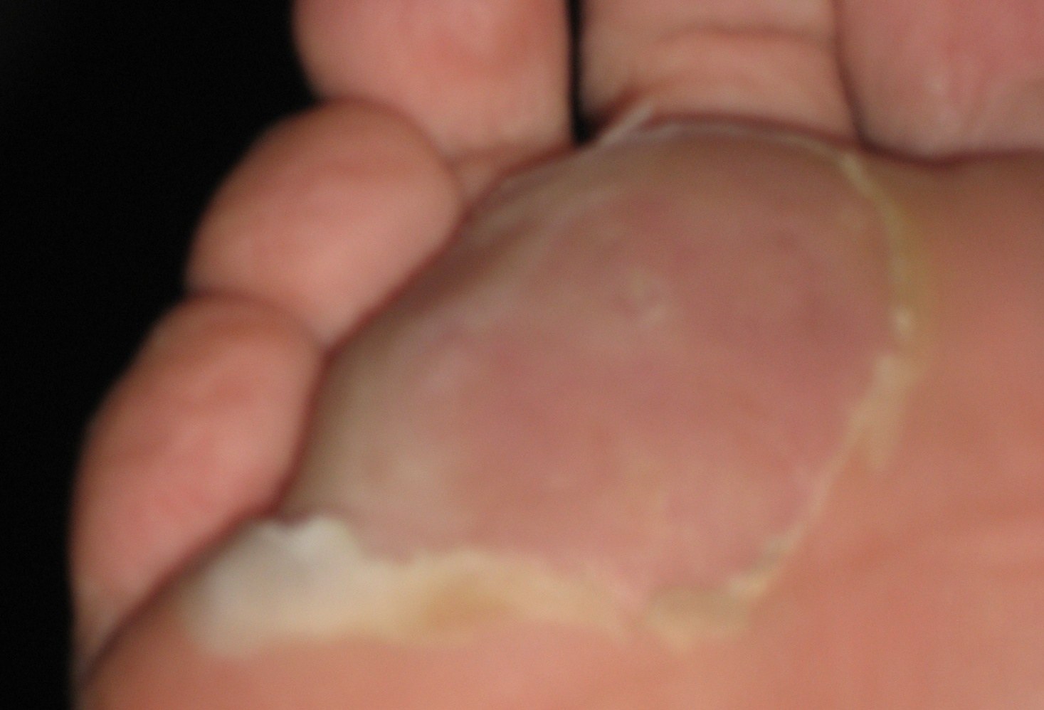 DS8 Blister recovered
